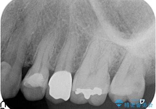 オールセラミッククラウン しみる歯の治療の治療後