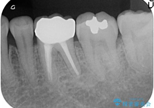 オールセラミッククラウン 根管治療後の補綴の治療後