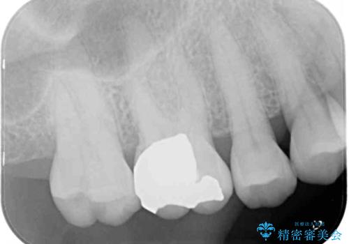 外れてしまった奥歯の銀歯 ゴールドインレーによる修復治療の治療前