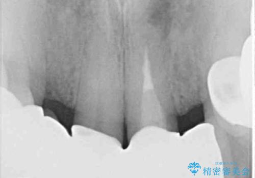 空気が抜けて話しにくい前歯のブリッジの作り直し オールセラミックブリッジにて審美的に仕上げるの治療後
