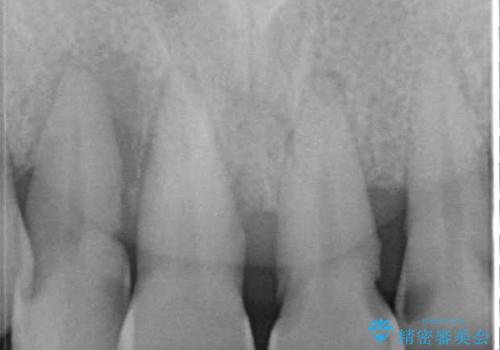 歯周病におかされた前歯の再建治療の治療前