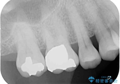 外れてしまった奥歯の銀歯 ゴールドインレーによる修復治療の治療後