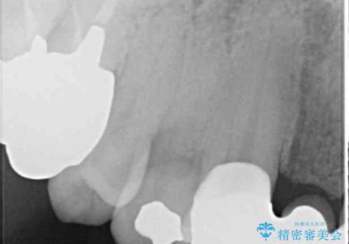 空気が抜けて話しにくい前歯のブリッジの作り直し オールセラミックブリッジにて審美的に仕上げるの治療後