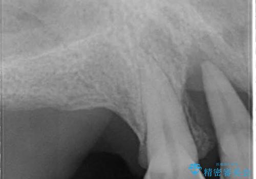 歯周病におかされた前歯の再建治療の治療前