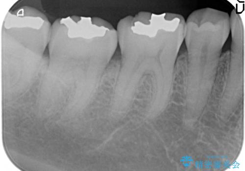 セラミックインレー 虫歯治療の治療前