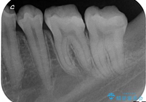 歯冠長延長術を併用した審美的セラミック治療の治療前
