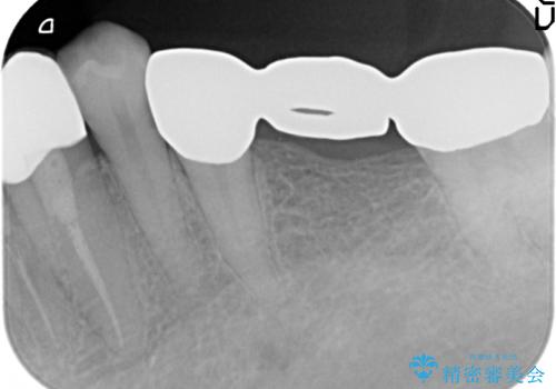 オールセラミッククラウン 銀歯を白い歯への治療前