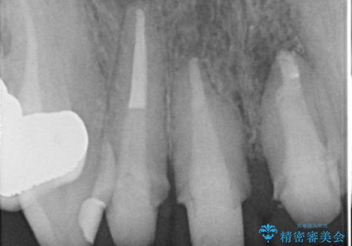 オールセラミッククラウン(スペシャル) 不揃いな前歯を美しくの治療中