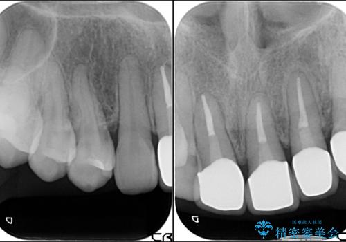 歯肉の高さをそろえたい　前歯の審美歯科治療の治療前