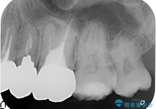 オールセラミッククラウン 根管治療・深い虫歯の治療の治療前
