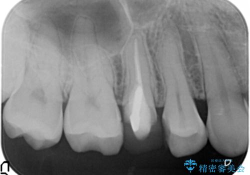 差し歯をもっと自然に 30代女性の治療前