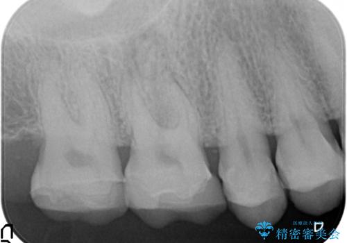 オールセラミッククラウン 根管治療後の補綴の治療前