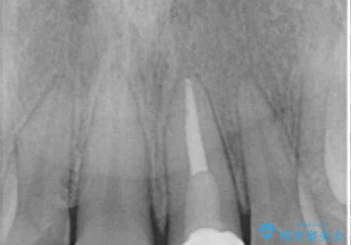 前歯の歯並びとクラウンを改善 インビザラインとオールセラミックの治療後