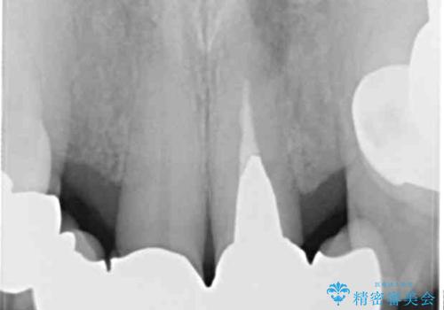 空気が抜けて話しにくい前歯のブリッジの作り直し オールセラミックブリッジにて審美的に仕上げるの治療前