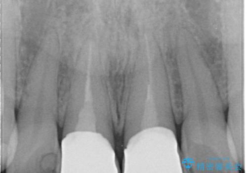 前歯の根元が黒い オールセラミッククラウンの装着による改善の治療後