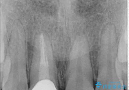 ぶつけて変色した前歯 オーダーメイドタイプのオールセラミッククラウンの治療後