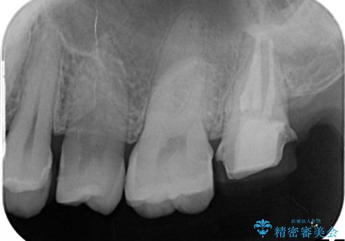 奥歯が痛い! 中途半端な治療をしっかりとやり治すの治療中