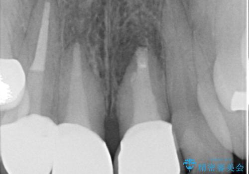 オールセラミッククラウン(スペシャル) 不揃いな前歯を美しくの治療後