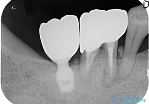 歯周病にて保存不可能な歯をショートインプラントで回復するの治療後