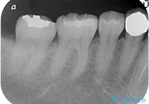 セラミックインレー 虫歯治療の治療後