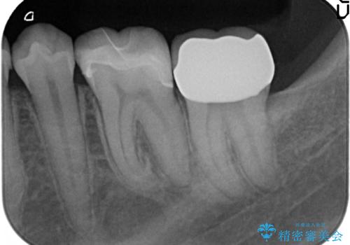 歯冠長延長術を併用した審美的セラミック治療の治療後