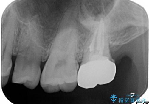奥歯が痛い! 中途半端な治療をしっかりとやり治すの治療後