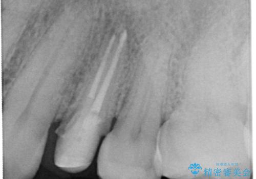 大きな虫歯で崩壊した歯の修復の治療中