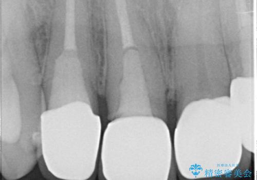 オールセラミッククラウン 土台ごと外れた前歯の補綴の治療前