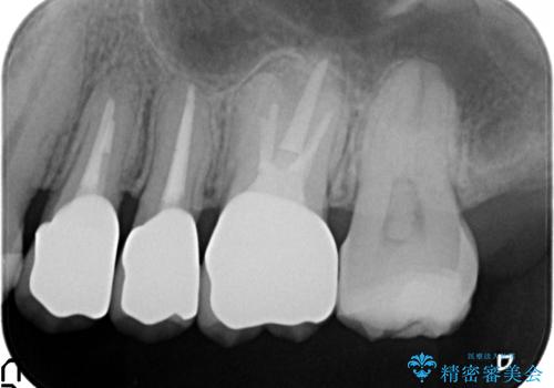 オールセラミッククラウン 根管治療・深い虫歯の治療の治療後