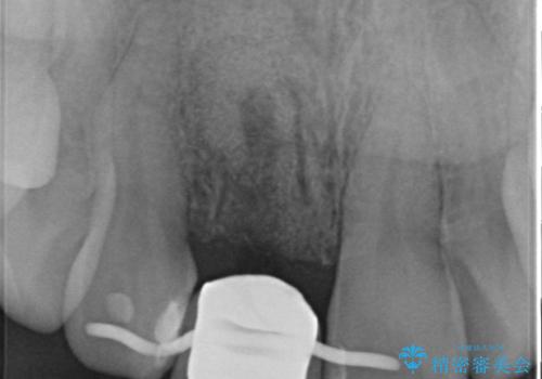 前歯 インプラントによる欠損補綴の治療前