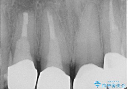オールセラミッククラウン 土台ごと外れた前歯の補綴の治療後