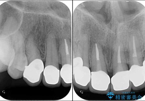 歯肉の高さをそろえたい　前歯の審美歯科治療の治療後