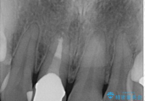 差し歯をもっと自然に 30代女性の治療後