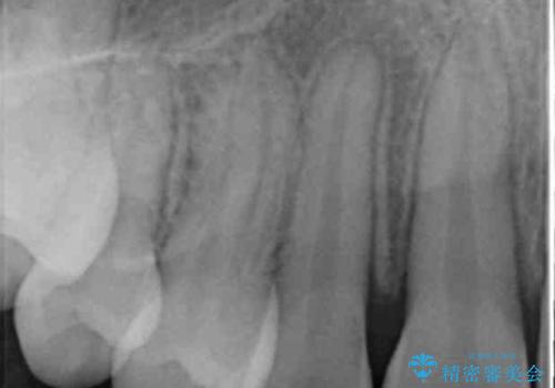 埋まっている犬歯を抜歯して、歯列矯正の治療後