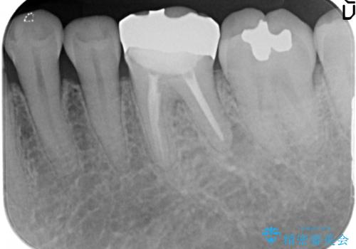 オールセラミッククラウン 根管治療後の補綴の治療前