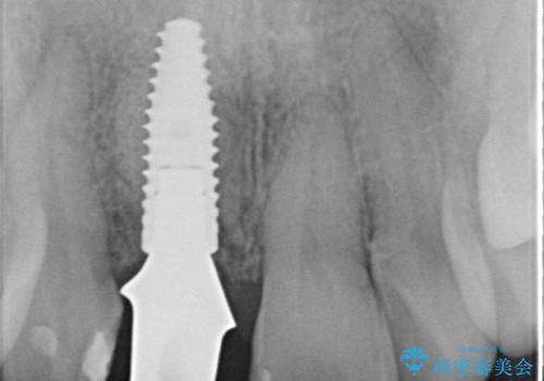 前歯 インプラントによる欠損補綴の治療中