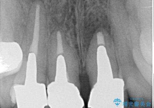 オールセラミッククラウン(スペシャル) 不揃いな前歯を美しくの治療前