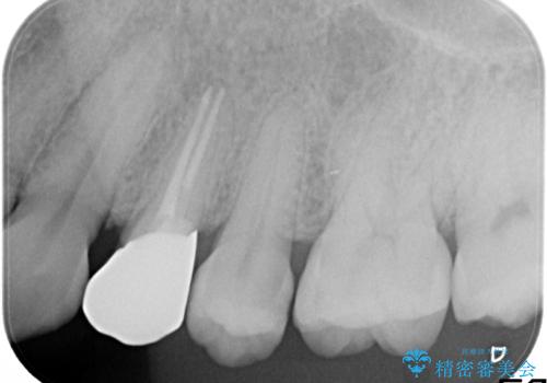 大きな虫歯で崩壊した歯の修復の治療後
