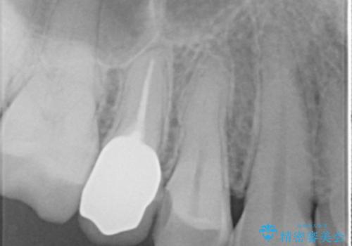 差し歯をもっと自然に 30代女性の治療後