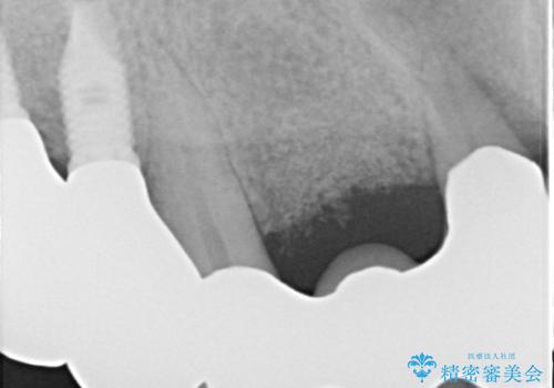 歯周病におかされた前歯の再建治療の治療後