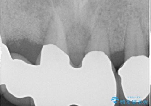 歯周病におかされた前歯の再建治療の治療後