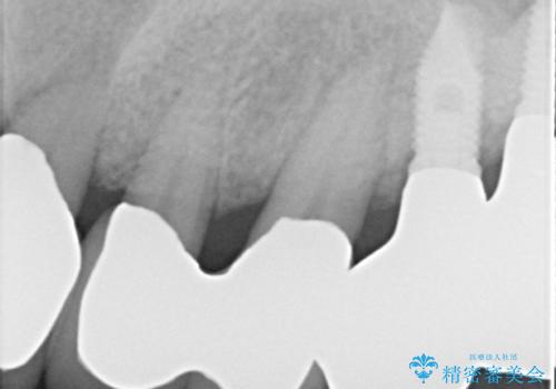 歯周病におかされた前歯の再建治療の治療後