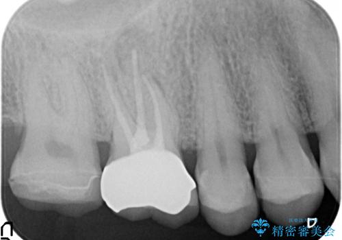 オールセラミッククラウン 根管治療後の補綴の治療後