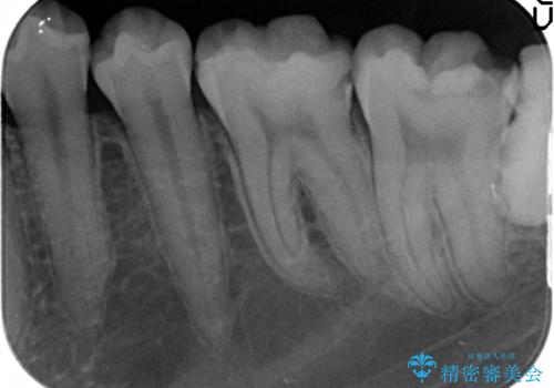 歯冠長延長術を併用した審美的セラミック治療の治療前