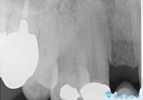 空気が抜けて話しにくい前歯のブリッジの作り直し オールセラミックブリッジにて審美的に仕上げるの治療前