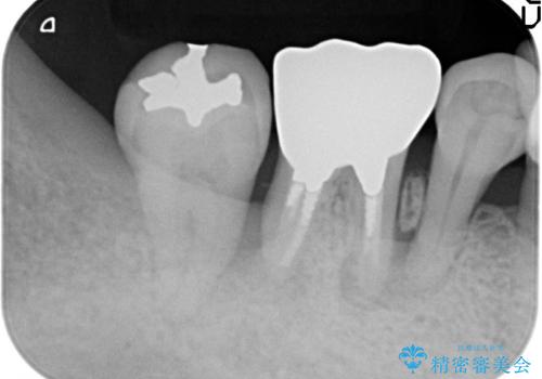 歯周病にて保存不可能な歯をショートインプラントで回復するの治療前