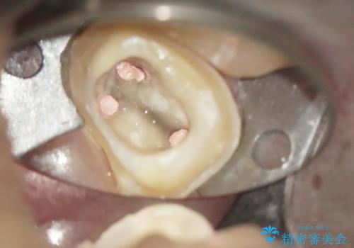 奥歯が痛い! 中途半端な治療をしっかりとやり治すの治療中