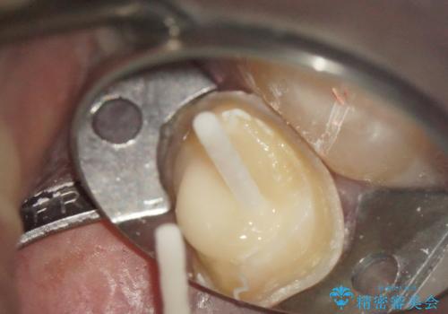 奥歯が痛い! 中途半端な治療をしっかりとやり治すの治療中