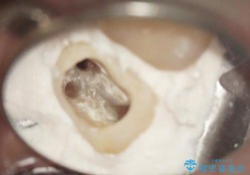 奥歯が痛い! 中途半端な治療をしっかりとやり治すの治療中