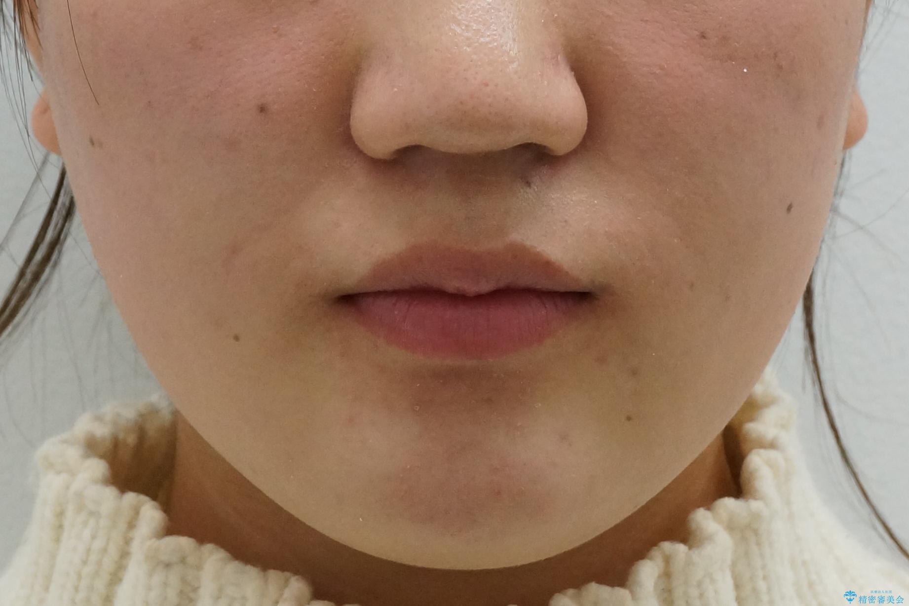 成人式に間に合う 前歯の矯正の治療後(顔貌)